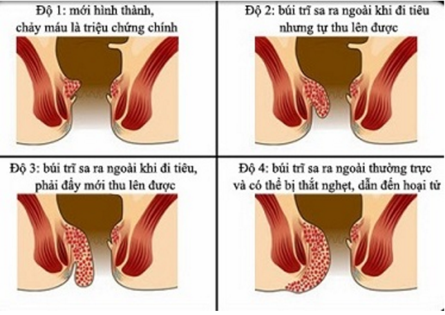 Giai đoạn trĩ